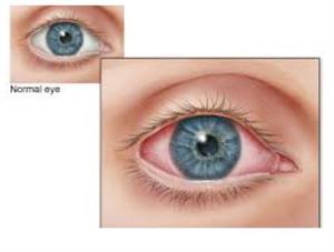 pink eye