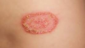 ringworm
